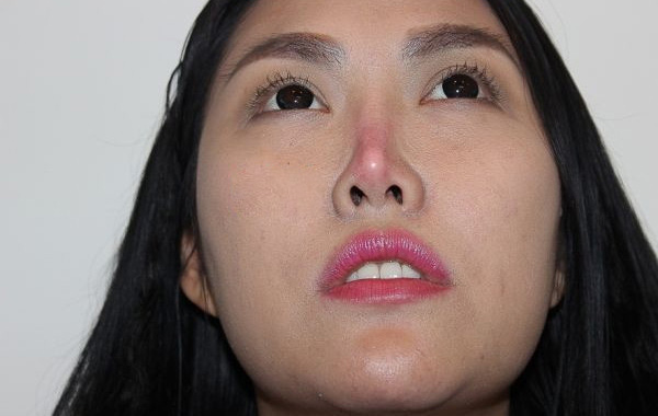 Các cách khắc phục biến chứng thường gặp sau nâng mũi
