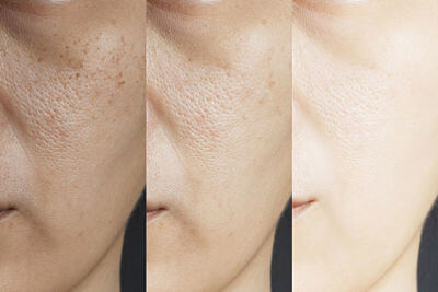 Tìm hiểu về những hoạt chất cải thiện lỗ chân lông trên da mặt